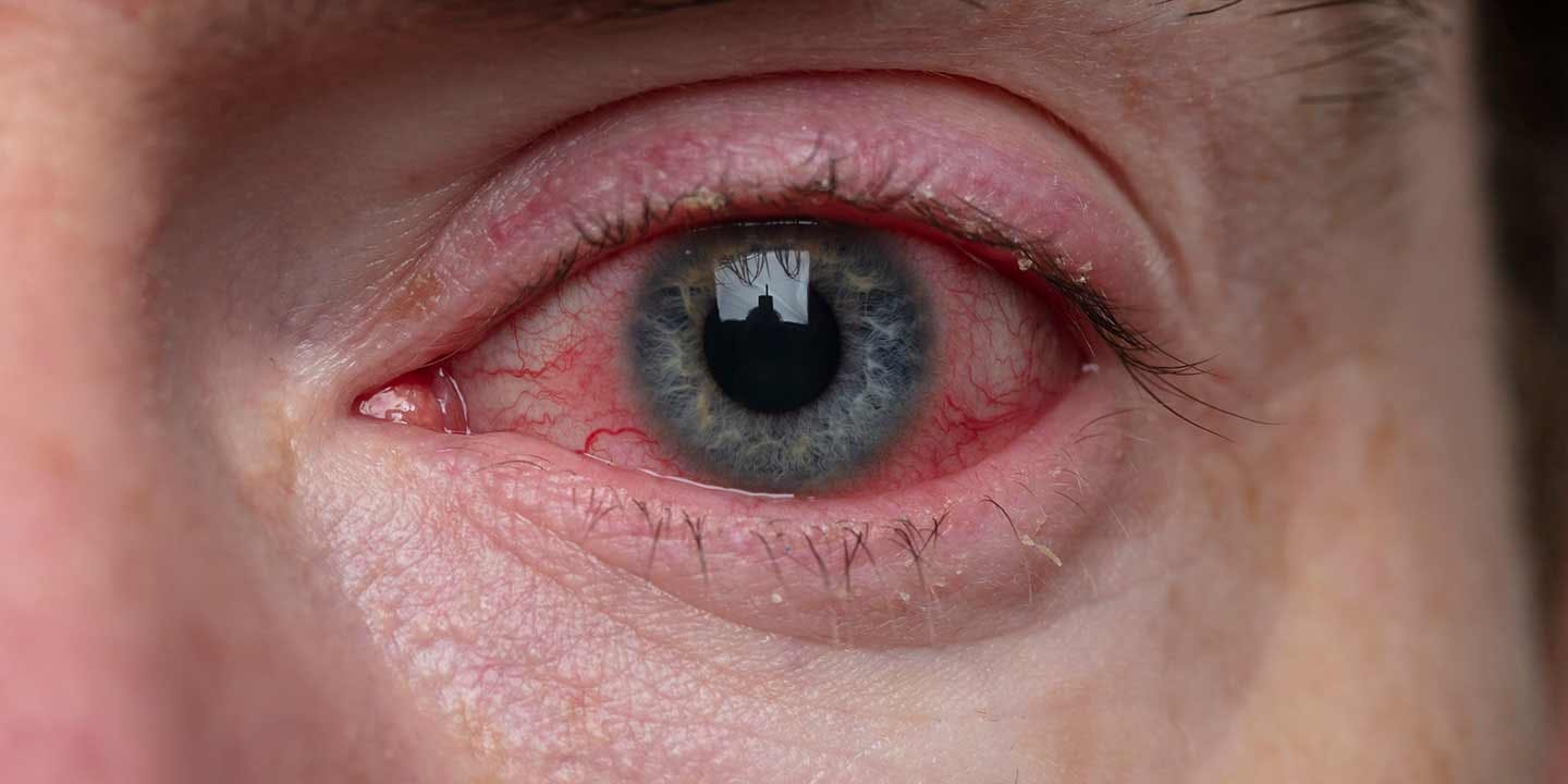 konjiktivitis1